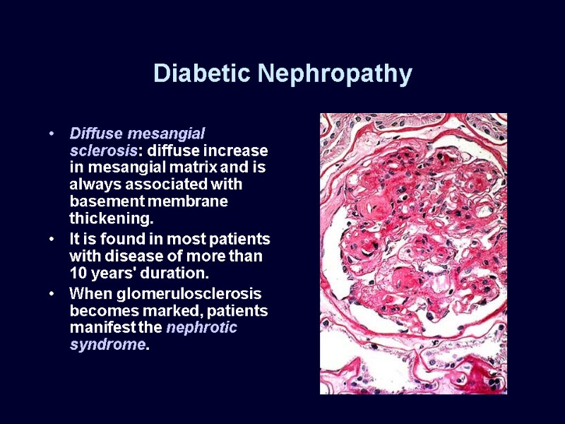 Diabetic Nephropathy Diffuse mesangial sclerosis: diffuse increase in mesangial matrix and is always associated